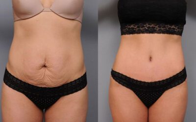 Understanding the Mommy Makeover: Options and Costs in South Africa