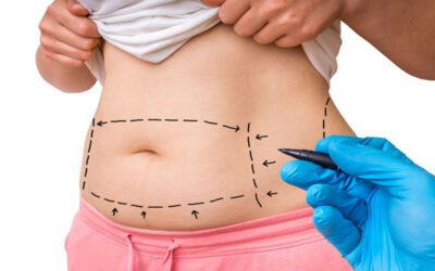The Real Benefit of the Tummy Tuck and Mommy Makeover