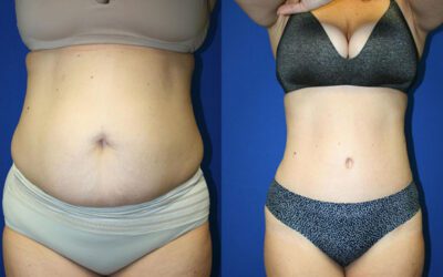 Where to Get a Tummy Tuck in Cape Town: Top Clinics and Surgeons