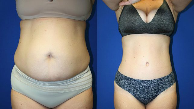The Complete Guide to Tummy Tuck Surgery in Cape Town