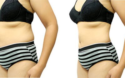 Mommy Makeover in South Africa | Complete Transformation, Costs, and Best Clinics