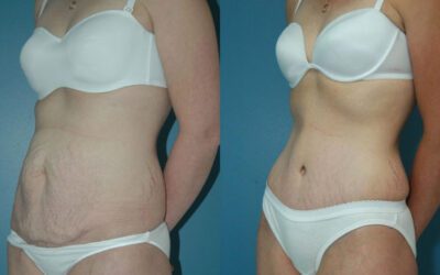 Tummy Tuck Cost in South Africa | A Comprehensive Guide to Budgeting for Your Procedure