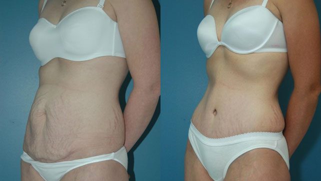 Tummy Tuck Cost in South Africa | A Comprehensive Guide to Budgeting for Your Procedure