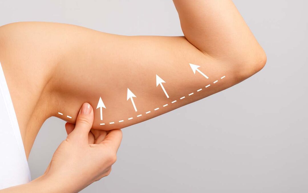 Why can an upper arm lift be a suitable post‐bariatric treatment? - Your Lipo
