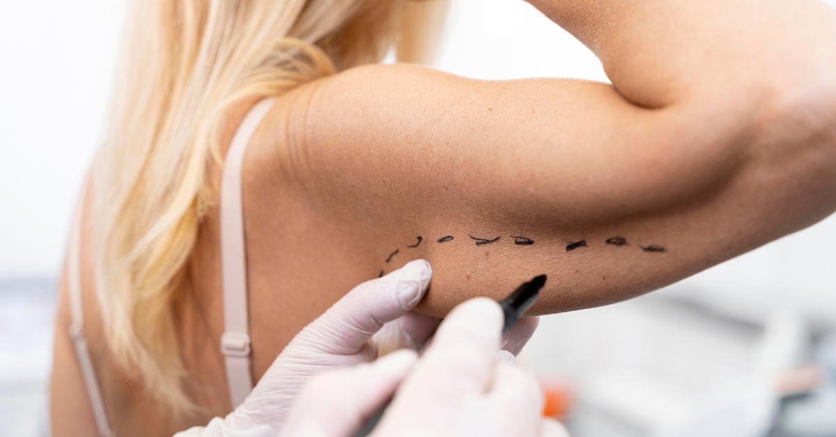 Top 7 Reasons to Get an Arm Lift After Weight Loss