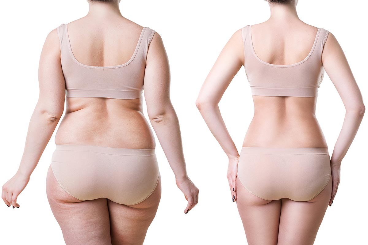 How to Know If You Are a Good Candidate for Liposuction