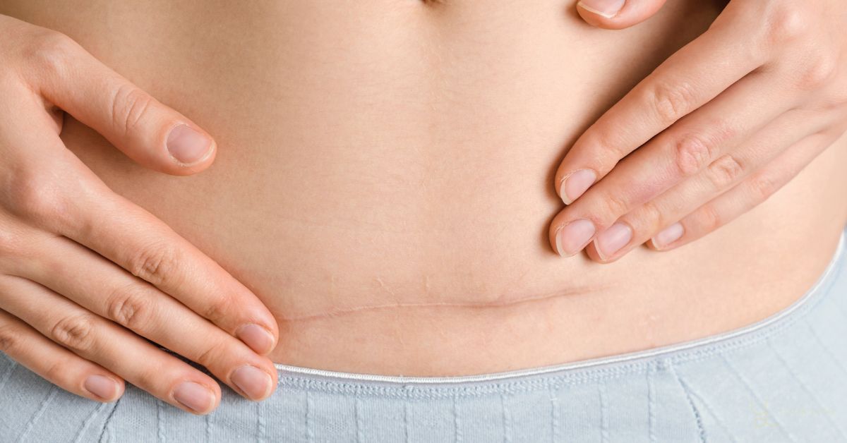 How to Minimise Scars After Liposuction Surgery